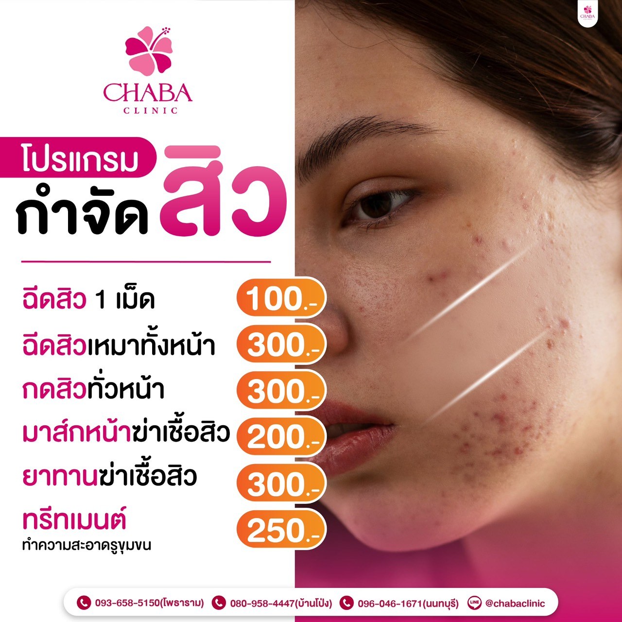Chaba Clinic promotion