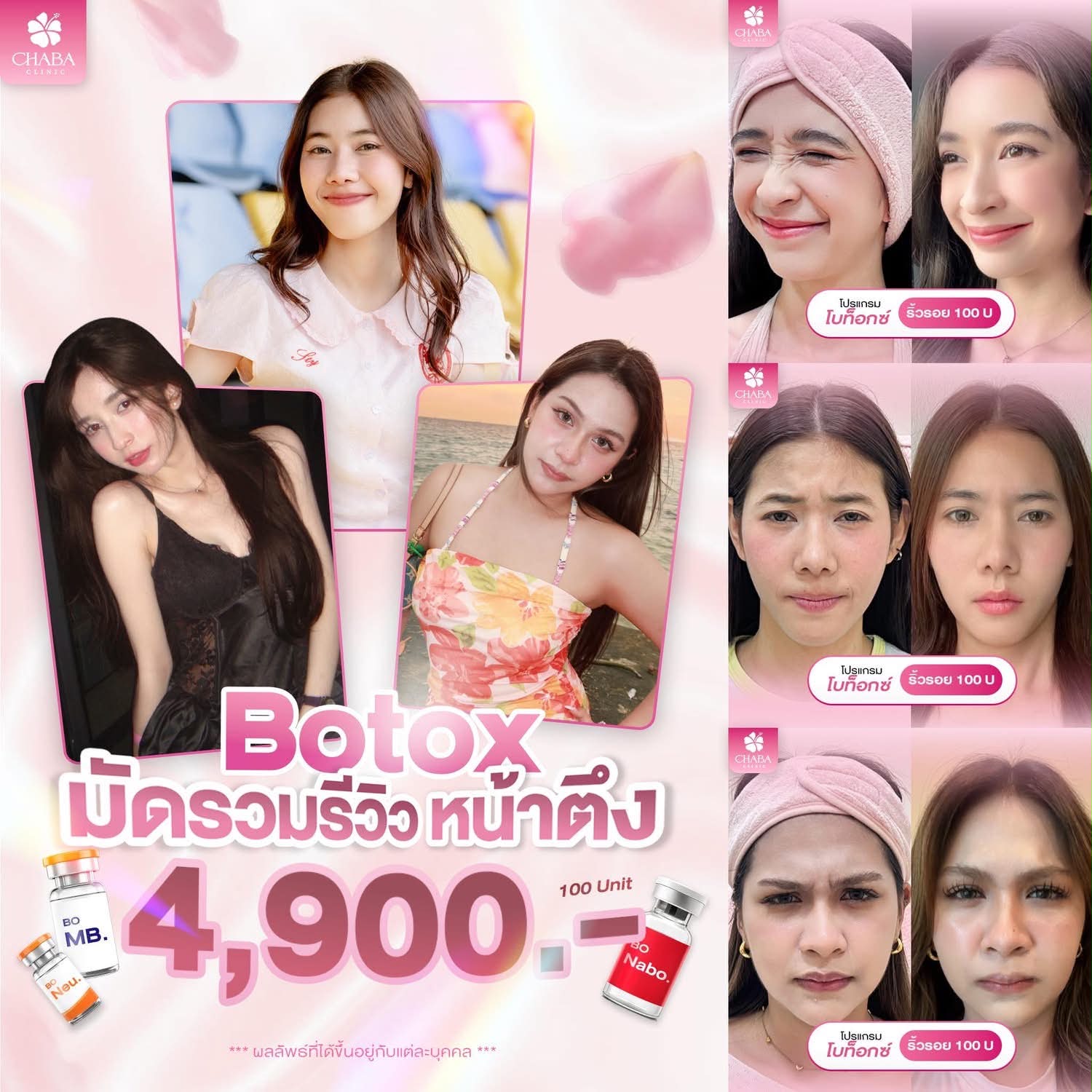 โปสเตอร์โปรแกรมโบท็อกซ์ CHABA Clinic