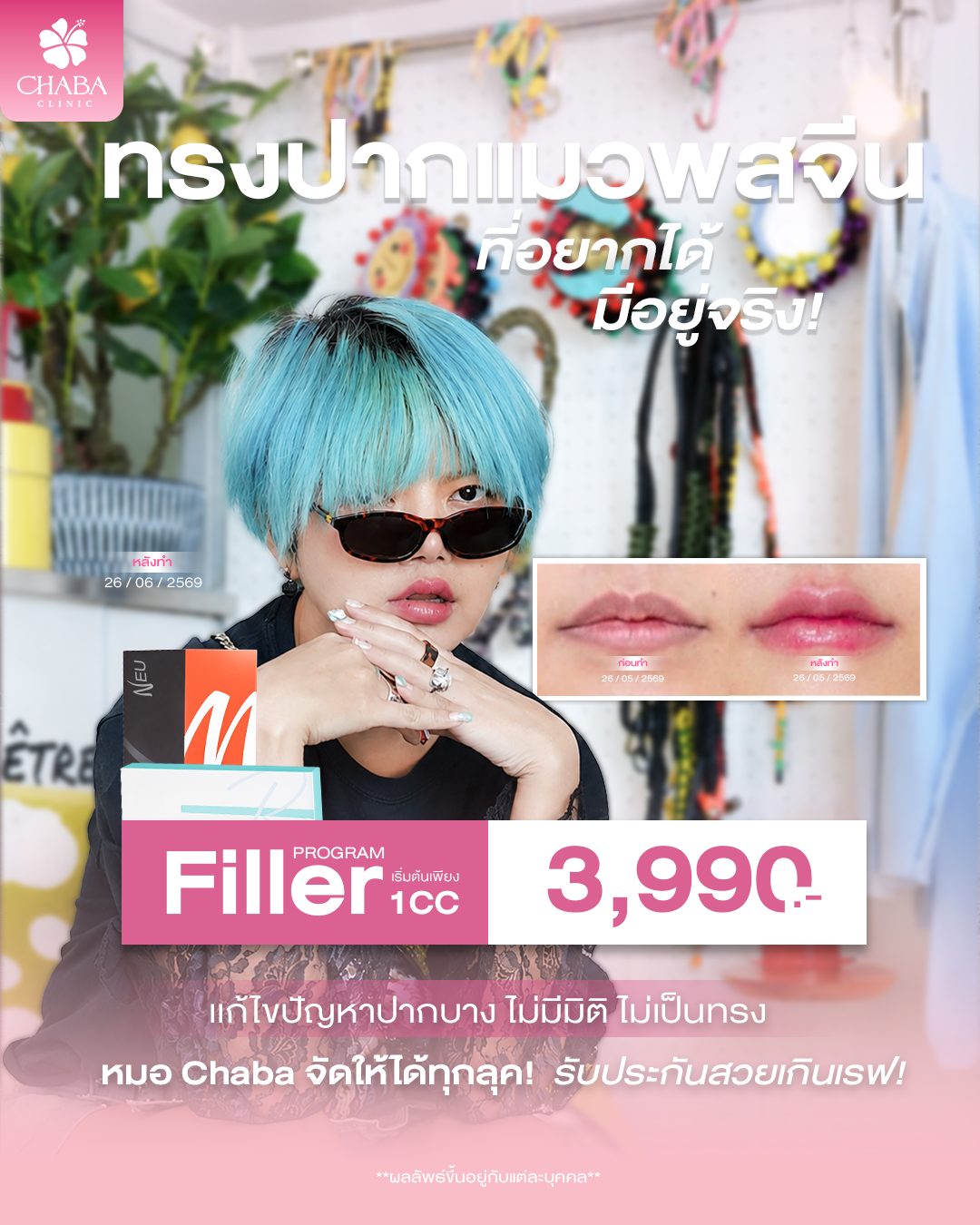 โปสเตอร์โปรแกรมฟิลเลอร์ CHABA Clinic