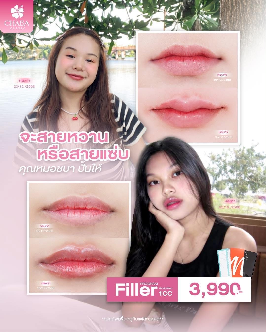 โปสเตอร์โปรแกรมฟิลเลอร์ริมฝีปาก CHABA Clinic