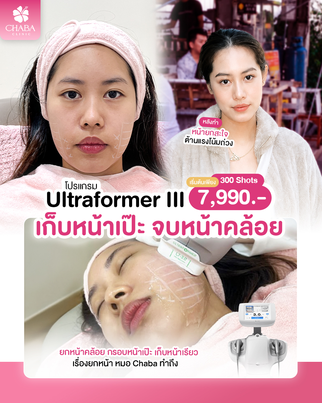 โปสเตอร์โปรแกรม Ultraformer III 300 ช็อต CHABA Clinic