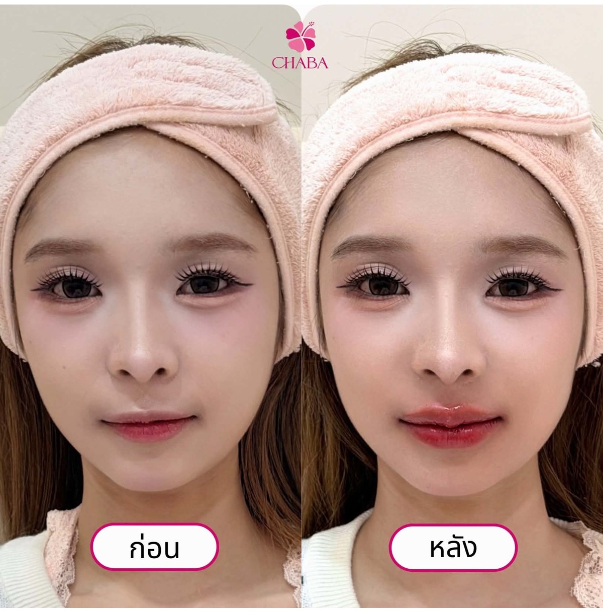 ผลลัพธ์ก่อนและหลังฟิลเลอร์ปาก