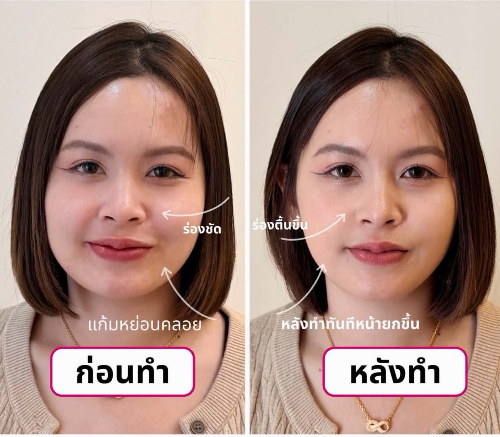 ภาพก่อนและหลังโปรแกรมดูแลความกระชับใบหน้าจากลูกค้า CHABA Clinic