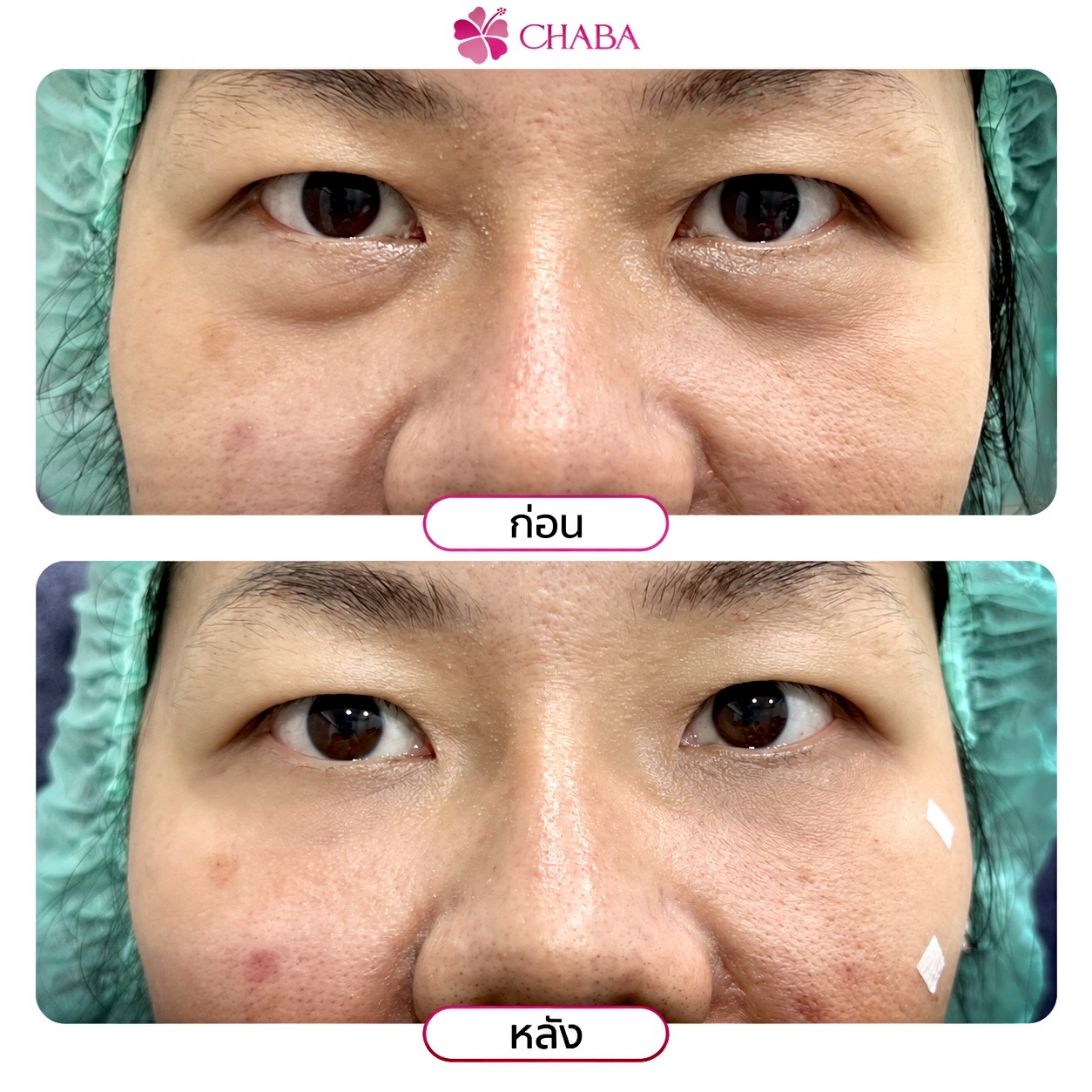 ภาพก่อนและหลังโปรแกรมดูแลบริเวณใต้ตาจากลูกค้า CHABA Clinic