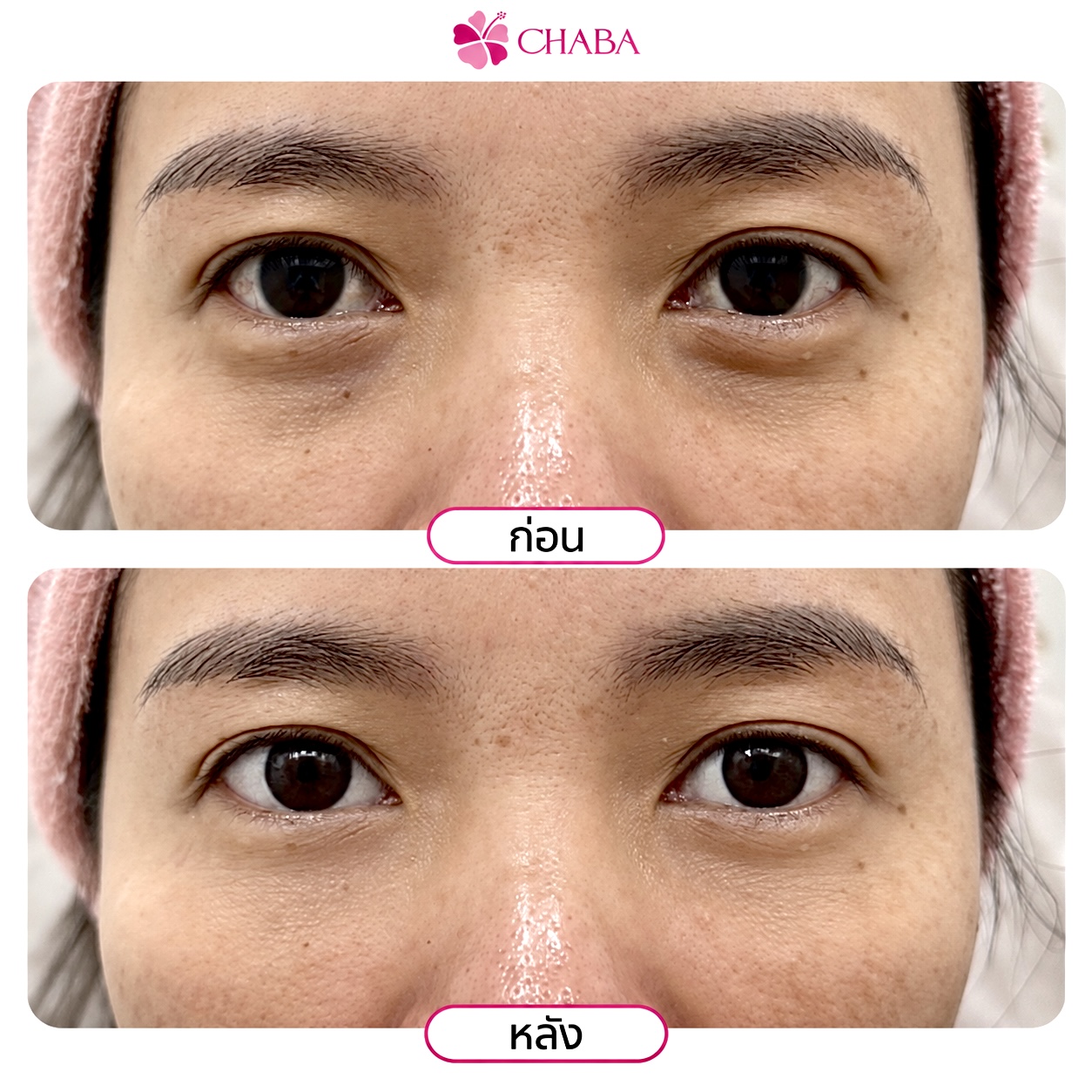 ภาพก่อนและหลังโปรแกรมดูแลรอบดวงตาจากลูกค้า CHABA Clinic