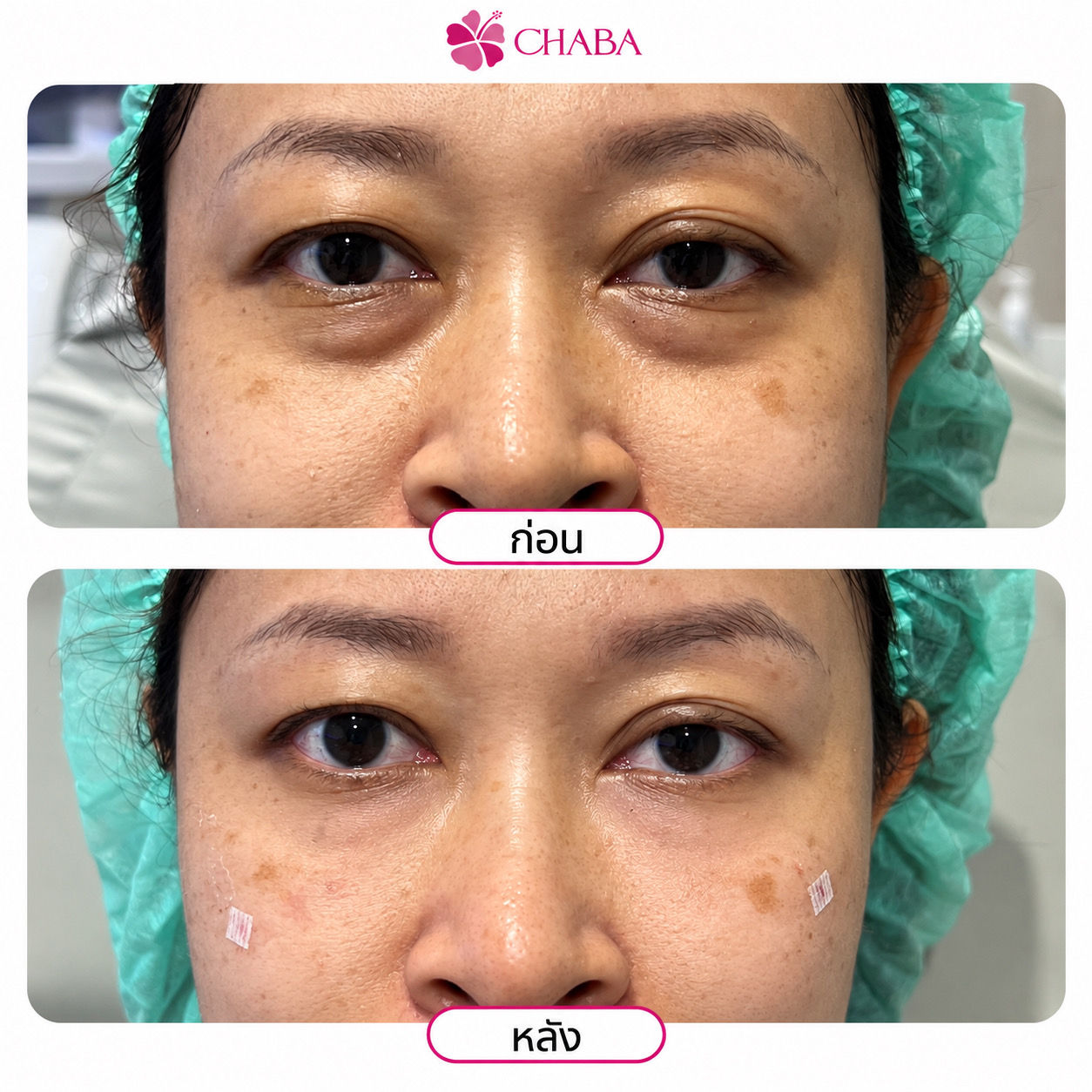 ภาพก่อนและหลังโปรแกรมดูแลใต้ตาจากลูกค้า CHABA Clinic