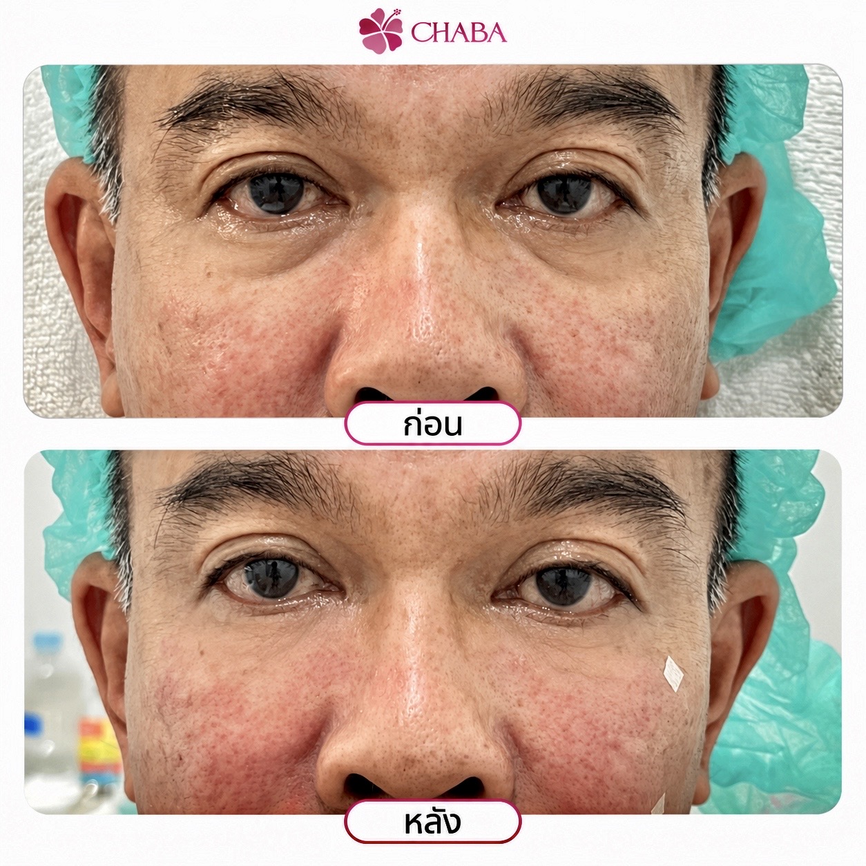 ภาพก่อนและหลังโปรแกรมดูแลรอบดวงตาจากลูกค้า CHABA Clinic