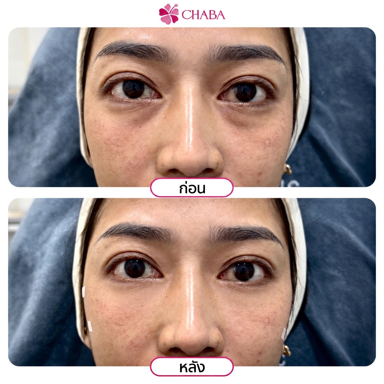 ภาพก่อนและหลังโปรแกรมฟิลเลอร์ใต้ตาจากลูกค้า CHABA Clinic