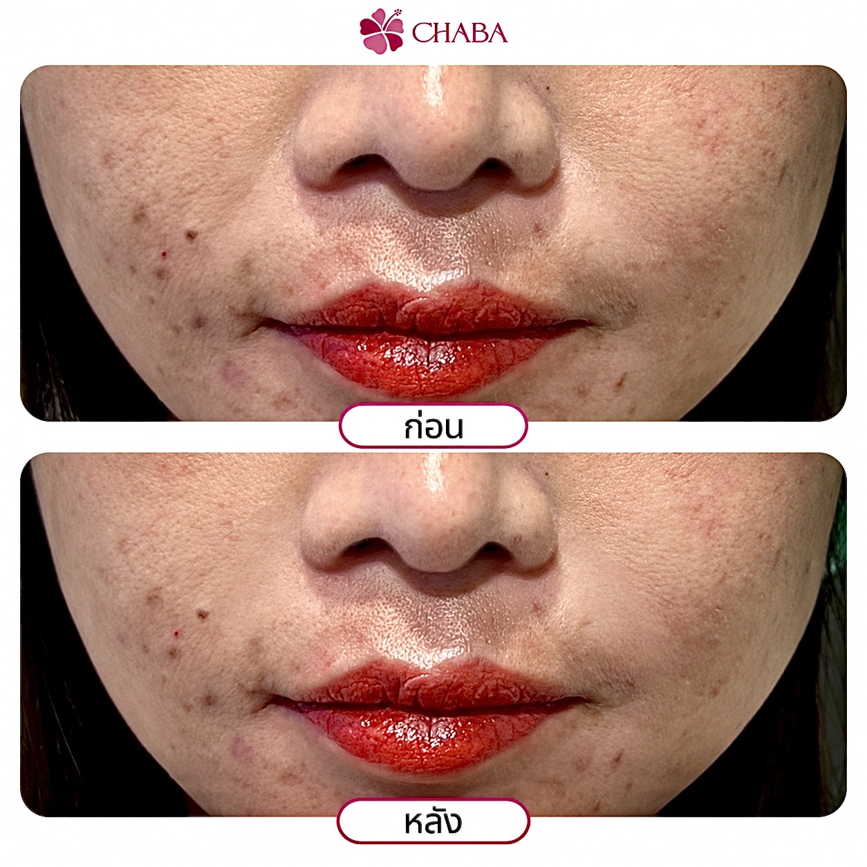 ภาพก่อนและหลังโปรแกรมฟิลเลอร์ร่องแก้มจากลูกค้า CHABA Clinic