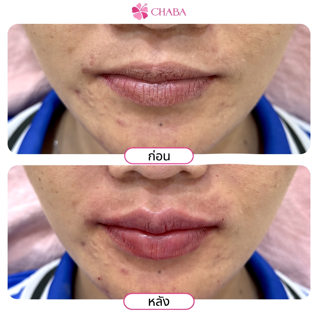 ภาพก่อนและหลังโปรแกรมดูแลรูปทรงริมฝีปากจากลูกค้า CHABA Clinic