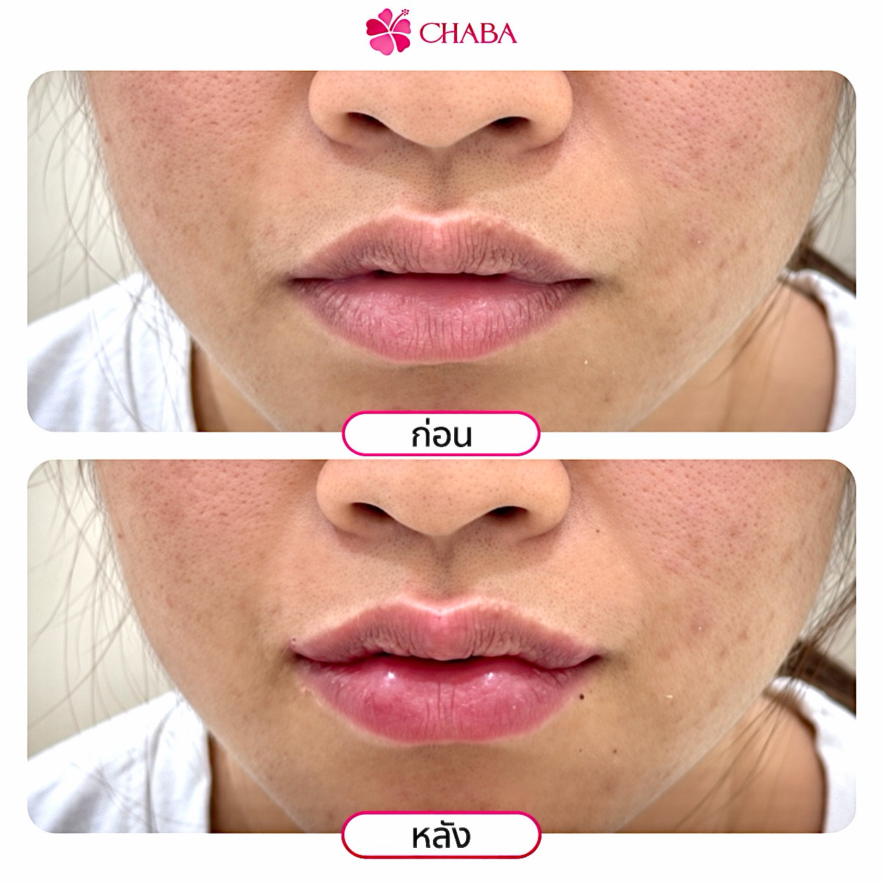 ภาพก่อนและหลังโปรแกรมฟิลเลอร์ริมฝีปากจากลูกค้า CHABA Clinic