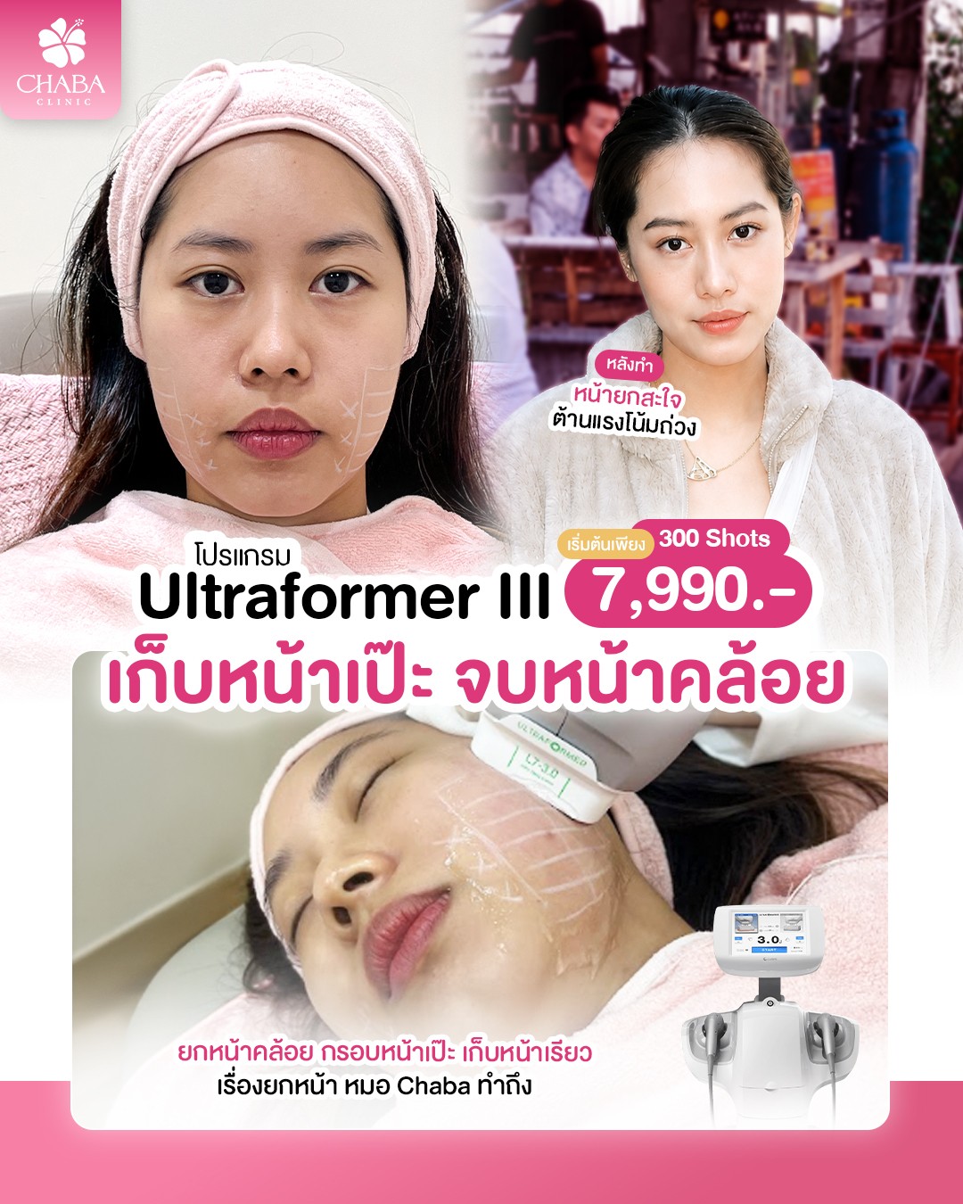 Ultraformer III ที่ Chaba Clinic